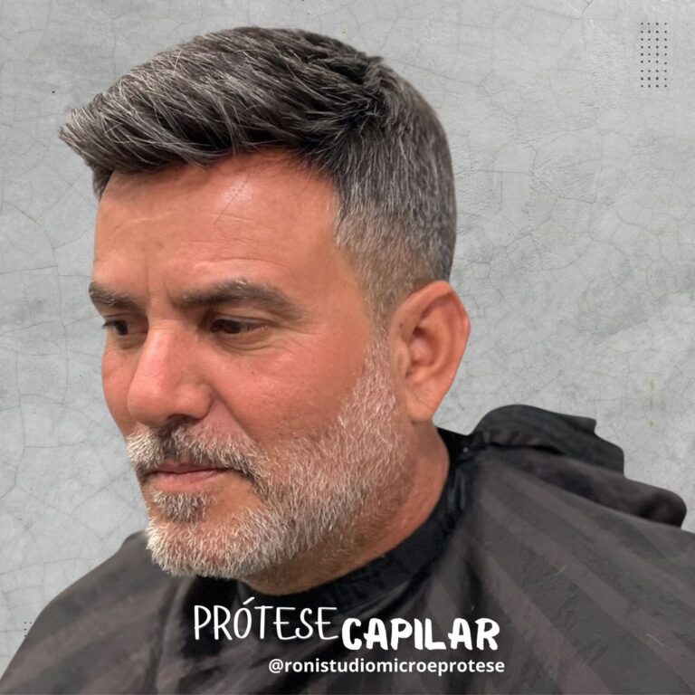 Prótese Capilar Masculina Campos dos Goytacazes