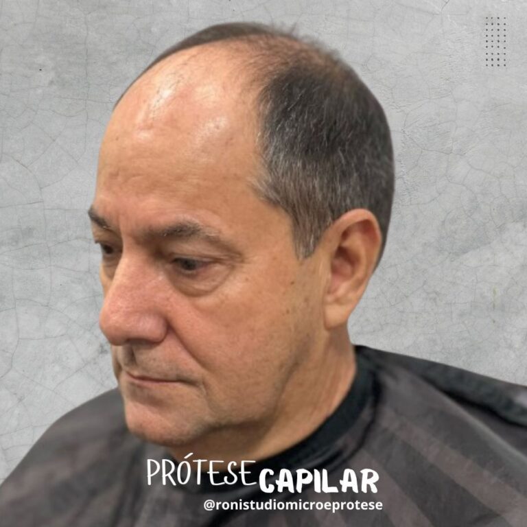 Prótese Capilar Masculina Itaperuna